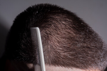 Messy hair. Hair with dandruff. Scalp problem, dandruff and dermatitis or eczema. Problem of dandruff. Hair disease seborrhea. Fatty Dandruff.