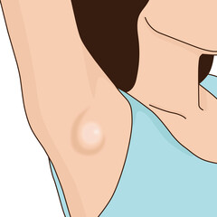 Woman raise hand up has lump in armpit inflammation, illustration on white background