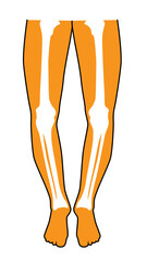 Illustration x-ray of bowlegs osteoarthritis knees on white background
