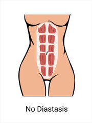 No Diastasis in a woman before and after pregnancy. The anatomy of a Woman. Woman muscular corset, body part. Vector illustration
