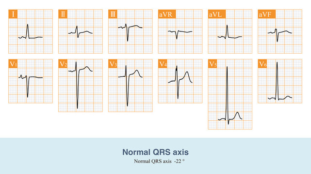 When the frontal QRS axis is -22 &deg;, it is oriented towards the upper left quadrant and projected onto the negative side of lead III axis, so the QRS main wave of lead III is negative.
