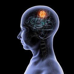 Obraz premium Brain tumor, 3D illustration. Meningioma, glioma, astrocytoma, and other brain tumors
