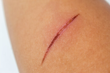 close up of cut wound on hand