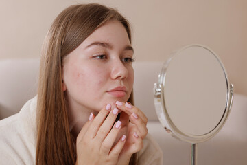 Teenage girl with acne examines her face in the mirror, highlighting skin imperfections and concerns about blemishes, skincare routine, and the challenges of adolescent skin health.