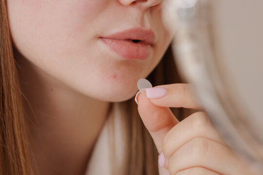 Young woman applies a hydrocolloid acne patch to her chin, highlighting modern, effective skincare and pimple treatment routines.