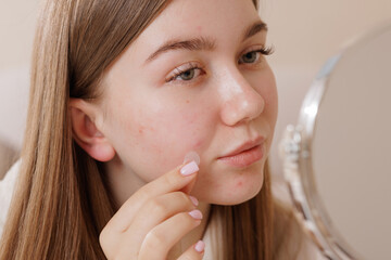 Young woman applies a hydrocolloid acne patch to her cheek, showing modern skincare, blemish treatment, and selfcare routine for clear, healthy skin.