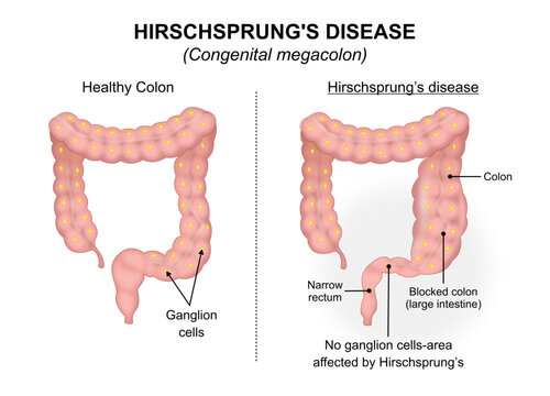 Hirschsprung's disease Congenital megacolon Illustration