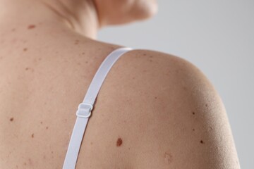 Woman with moles on her body against light background, closeup