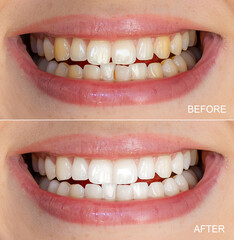 Comparison of teeth before and after a whitening treatment for brighter smiles