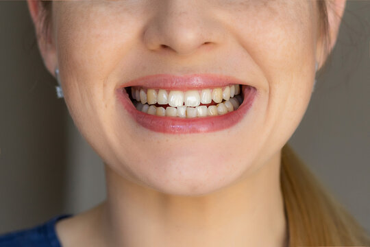 woman show smile with yellow teeth - Powered by Adobe