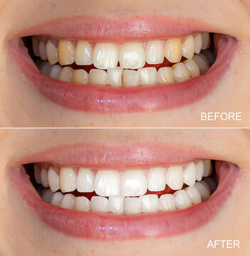 Comparison of teeth before and after a whitening treatment for brighter smiles