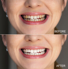 Comparison of teeth whitening results shown in before and after perspective