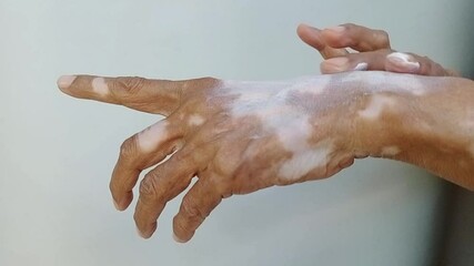 The hand of an asian old woman with a skin problem called vitiligo is being applied with cream.