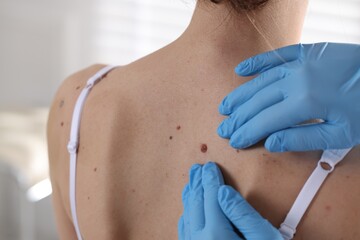 Doctor examining woman's moles in hospital, closeup