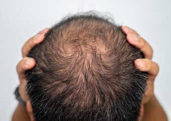 A bald spot on men's head. Baldness is related to your genes and male sex hormones. It usually...