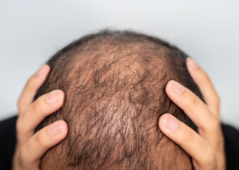 Asian man having stress cause of baldness problem. Baldness is related to your genes and male sex...