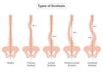 Scoliosis is a condition characterized by an abnormal curvature of the spine.
