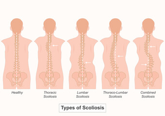 Scoliosis is a condition where the spine curves abnormally to the side.