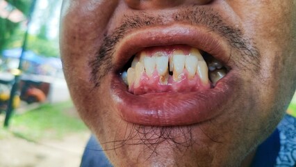 close-up of a person's open mouth, focusing on their teeth and gums. The individual appears to have...
