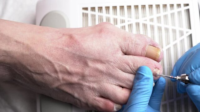 Professional hardware pedicure, ingrown toenail, elderly woman with cracked skin on her foot at a podiatrist's appointment, chiropody and podology concept