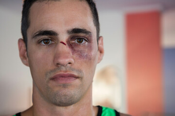 Fototapeta premium Man in early 30s wearing green tank top showing bruised eye and nose cut inside gym