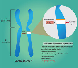 Information infographic of Williams syndrome that's a genetic disorder resulting from the loss of multiple genes in the 7q11.23 region of chromosome 7.	