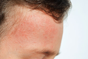 Red rashes from the Coxsackie virus on a child face on white background. Chickenpox symptoms on children's skin close-up