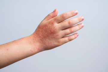 Red rashes from Coxsackie virus on a child hand close up. Chicken pox and allergy symptoms on skin on children's body on a white background