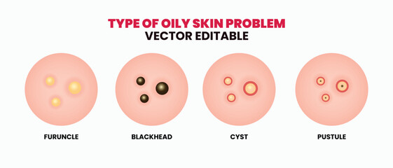 Types of oily skin problems, pimples, skin pores, blackhead, whitehead, scar, comedone. Vector icons of skin acne pimples, cosmetology and skincare problems.