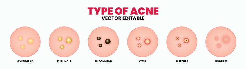 Types of acne, pimples, skin pores, blackhead, whitehead, scar, comedone. Vector icons of skin acne pimples, cosmetology and skincare problems.