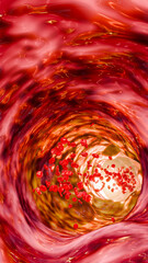Artery narrowing due to cholesterol deposits, fast food intake, high-sugar beverages, alcohol addiction, processed foods, emphasizing risks hypertension, stroke, cardiovascular death. 3D rendering