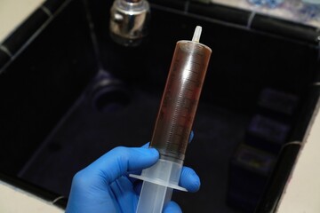 The doctor holds a sample of pleural fluid in a syringe with blue gloves, ready for cytological...