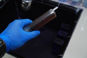 The doctor holds a sample of pleural fluid in a syringe with blue gloves, ready for cytological examination, malignant cells. Pleural effusion