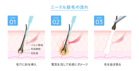 ニードル脱毛 施術の流れ