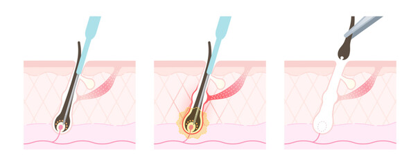 ニードル脱毛 施術の流れ