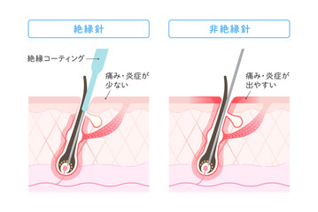 ニードル脱毛 絶縁針と非絶縁針の違い
