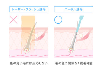 ニードル脱毛のメリット 毛の色に関係なく脱毛可能