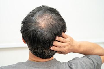 Fototapeta premium Bald in the middle head and begin no loss hair glabrous of mature Asian business smart active office man.