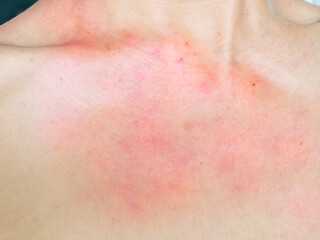 Fototapeta premium Woman with urticaria allergy itchy rash eczema itch neck from food,air poisoning,cosmetic,health,body vare disease lilness air,dissease medicine calamine lotion treatment,infection pain sick scratch.