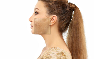 Dark spots, freckles,hyperpigmentation(melasma or chloasma),concept- skin lightening, skin...