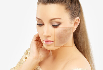 Dark spots, freckles,hyperpigmentation(melasma or chloasma),concept- skin lightening, skin...