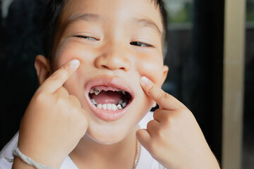 This boy lost his teeth from eating sweets and nibbles, which is likely due to natural loss. His...
