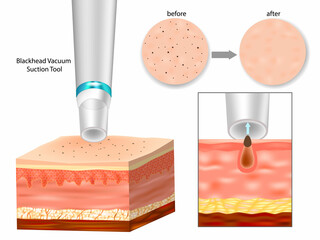 Vacuum Pore Cleaner Extracting Blackhead – Before and After Skin Comparison. Blackhead Removal Process Using Vacuum Suction Tool