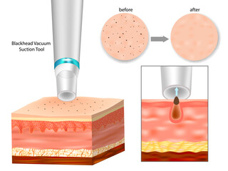 Vacuum Pore Cleaner Extracting Blackhead – Before and After Skin Comparison. Blackhead Removal Process Using Vacuum Suction Tool