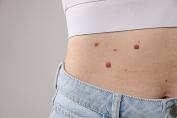 Woman with moles on her body against light background, closeup
