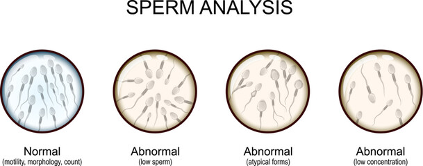 Sperm analysis. Male fertility test. fertility treatment