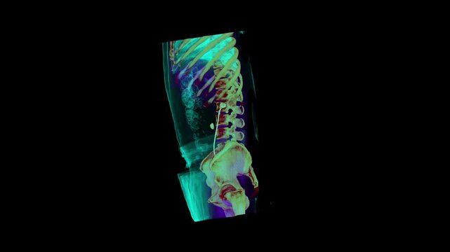 abdomen CT scan 3d rendering showing kidney stone and Dj stent 
abdomen CT scan 3d rendering showing kidney stone and Dj stent JJ stent (down left) in a urinary system. 

