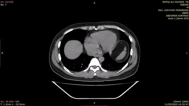 duplicated collecting system,CT scan
duplex collecting system, or duplicated collecting system,the kidney has two pelvicalyceal systems

