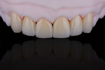 High-quality six dental crowns made of zirconium for fixation to the frontal teeth of upper jaw.