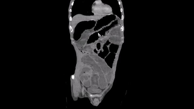 Ileus , small bowel obstruction, abdomen ct scan 
